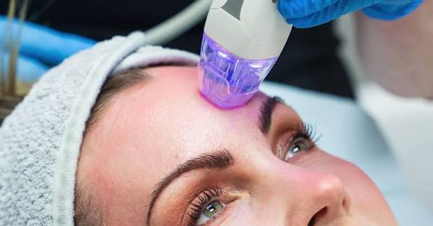 Diodenlaser Haarentfernung